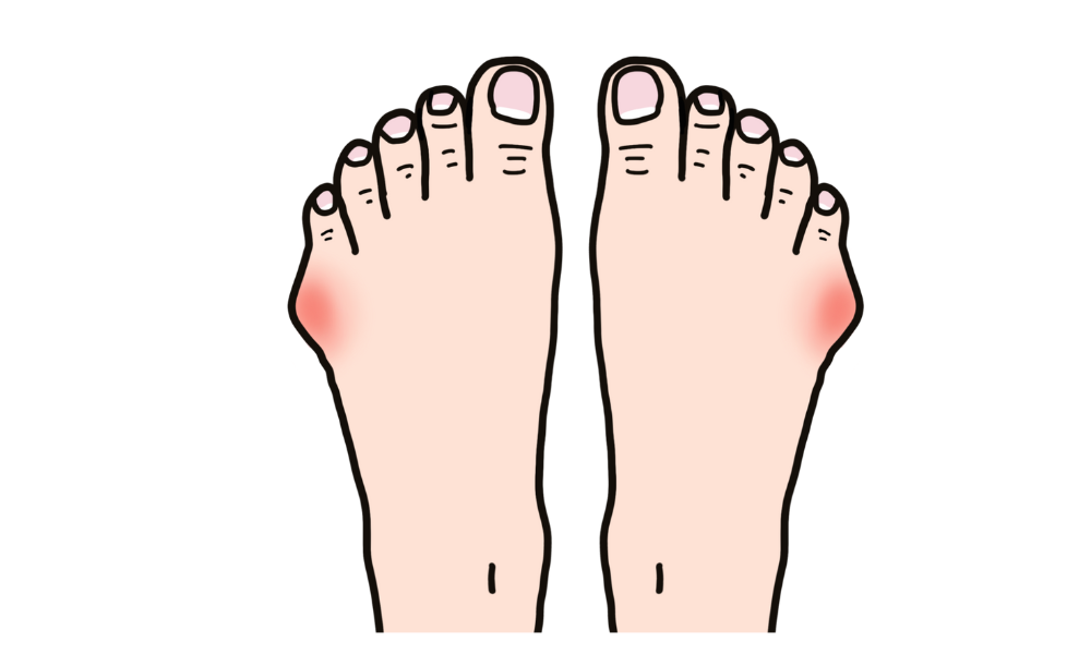 足のトラブル：内反小趾